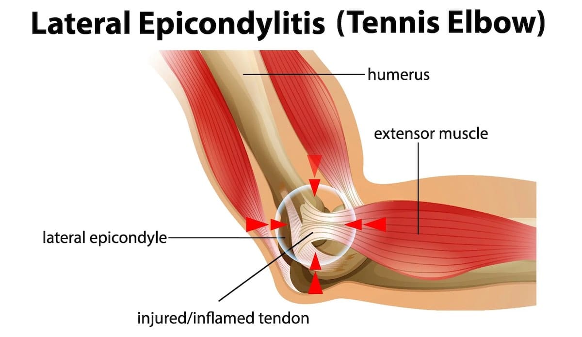 Cotovelo de ténis, ou "Epicondilite Lateral" condição médica. Fonte da imagem: news-medical.net.